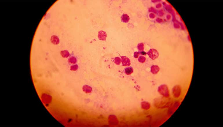 Leishmaniasis shows up red in an orange image of a petri dish against a black background