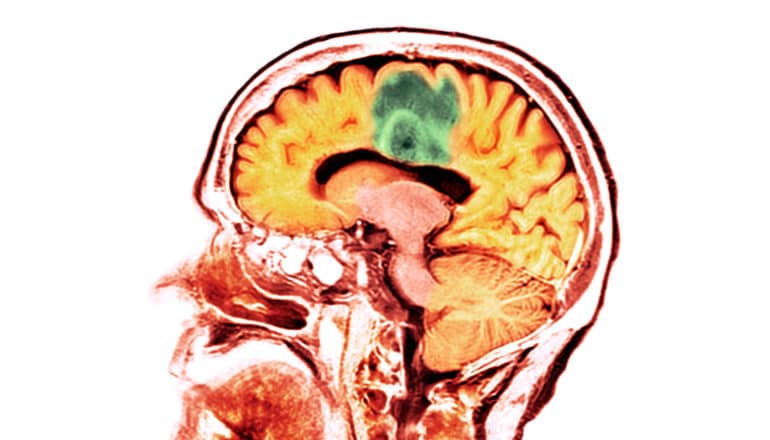 An orange and red CT scan of a human head and brain shows a tumor in green