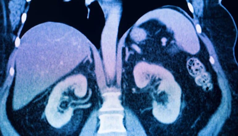 MRI scan shows kidneys, spine, liver