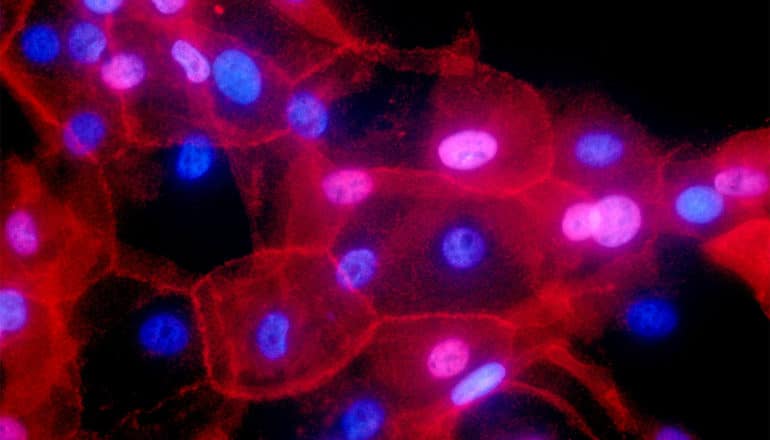 Breast cancer cells show up red with purple and blue nuclei against a black background
