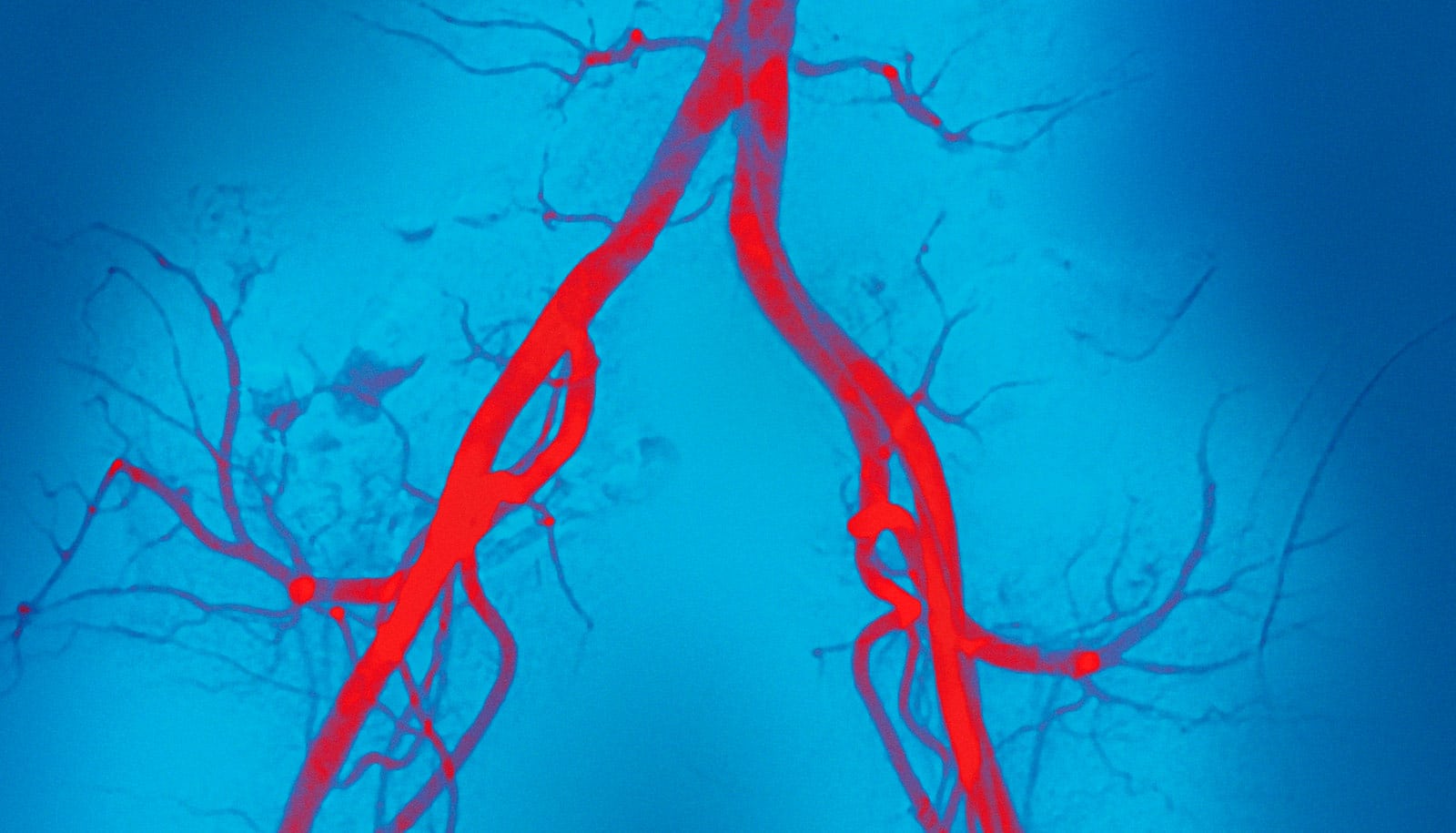 Расширение артериальных сосудов. Снимок кровеносных сосудов. Артерии красиво.