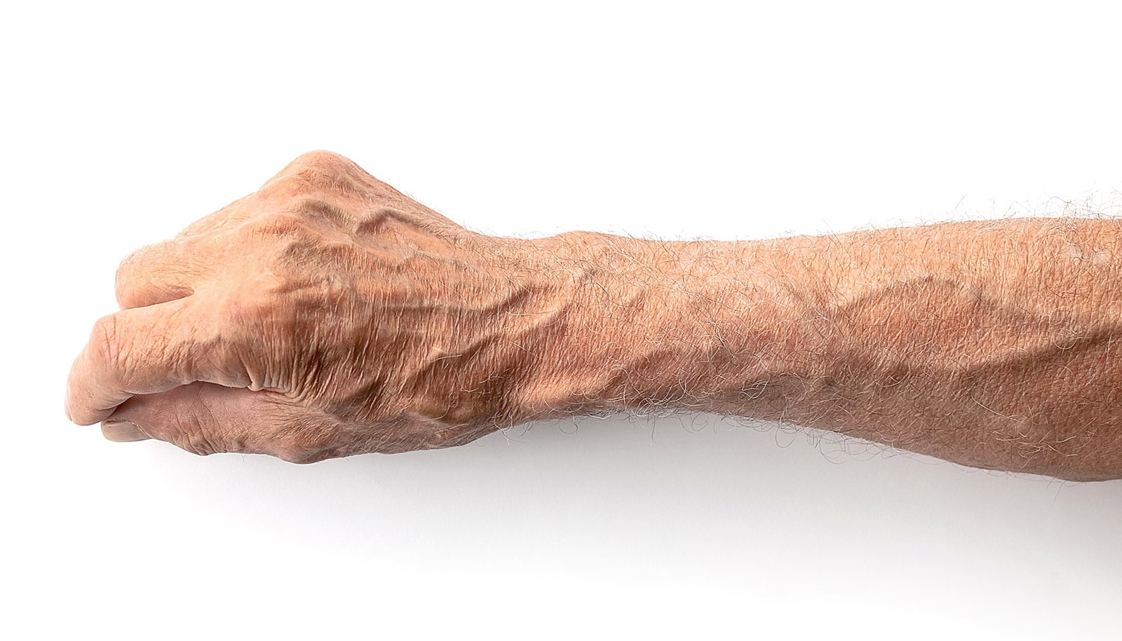 Case study COVID 19 brought on blood clots in arm Futurity