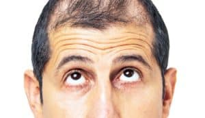 A man looks upward to his thinning hair.