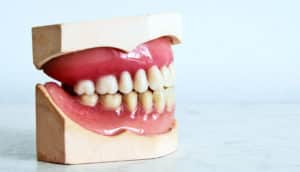 A model of teeth and gums sit on a white marble surface.