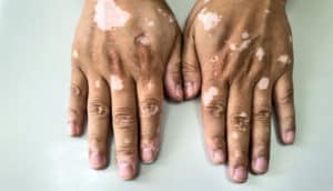 brown-skinned hands with white patches