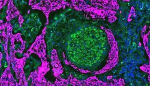 The green nerve is surrounded by purple cancer cells.