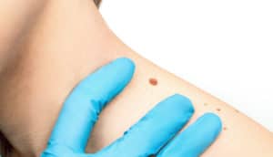 A doctor wearing a blue glove examines a large mole on a person's neck.