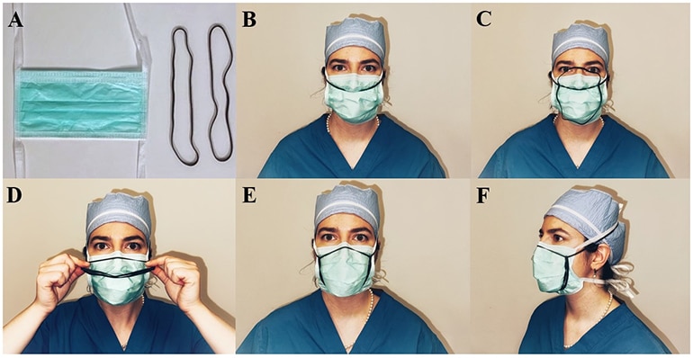 Fotografier af den simple modifikation, der viser, at en person tager den modificerede maske ordentligt på. (A) Modificerede maskekomponenter består af en standard ASTM Level 1 kirurgisk maske og to 8" gummibånd. (B) Mens du bærer en ASTM Level 1 kirurgisk maske, som er blevet justeret til at passe langs næseryggen, påfør et 8" gummibånd langs hovedets krone og placer forsiden af ​​gummibåndet under næsen. (C) Tag endnu et 8” gummibånd og påfør det vinkelret under det første gummibånd, så der dannes to løkker over og under det første gummibånd. (D) Flyt det første gummibånd, så det er over næseryggen, og fold det andet gummibånd på midten langs sig selv langs det første gummibånd på den vandrette akse. € Placer det andet gummibånd langs kinderne og under hagen. Juster begge gummibånd efter behov for at opnå en fuld forsegling som vist i denne forfra af den endelige konstruktion. (F) Sidebillede af den endelige konstruktion.