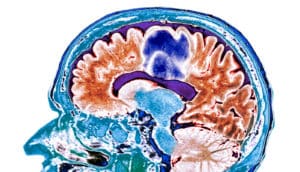 A brain scan shows glioblastoma highlighted in blue.