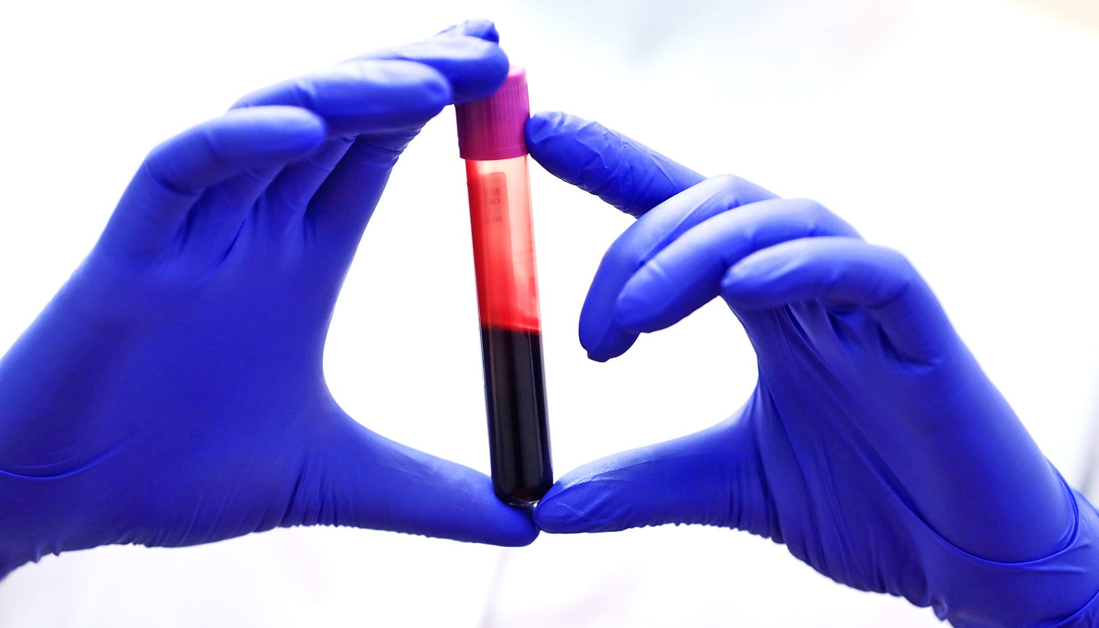 En person, der bærer lilla medicinske handsker, holder et plastikhætteglas med blod med en lilla top på.