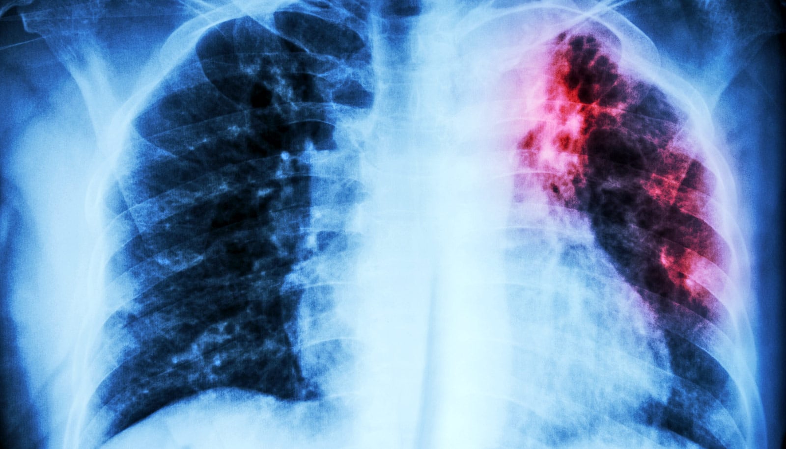Ein Lungenscan mit etwas roter Färbung, um auf Tuberkulose hinzuweisen.