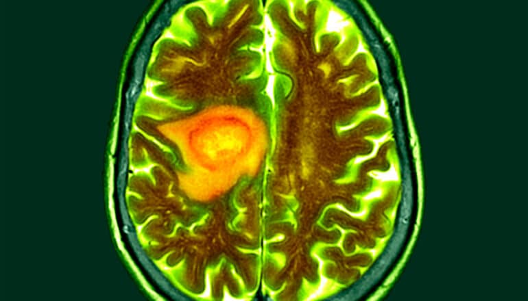 A scan of a brain with glioblastoma colored in yellow.