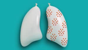 Two white balloons shaped like lungs with one covered in orange spots.