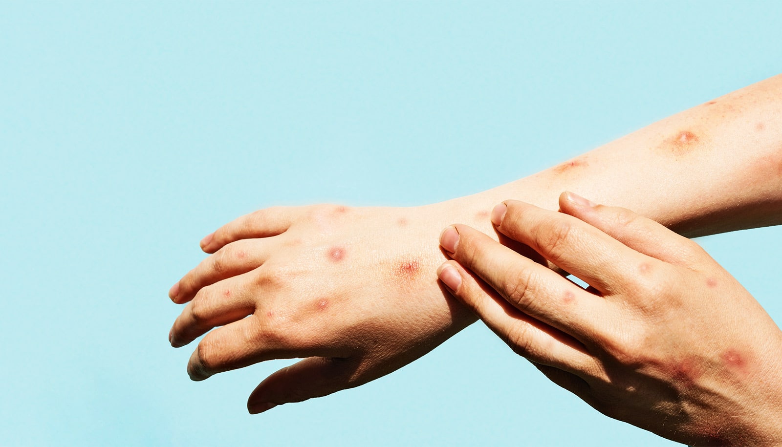 Molekül könnte Herpes behandeln, der Windpocken und Gürtelrose verursacht