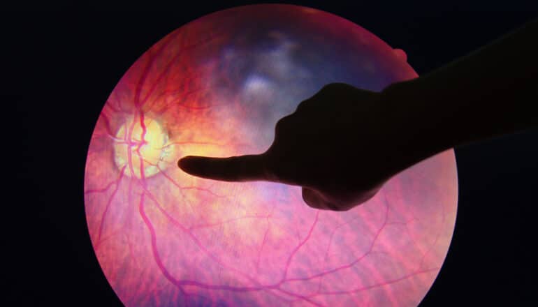 hand points to retinopathy on eye
