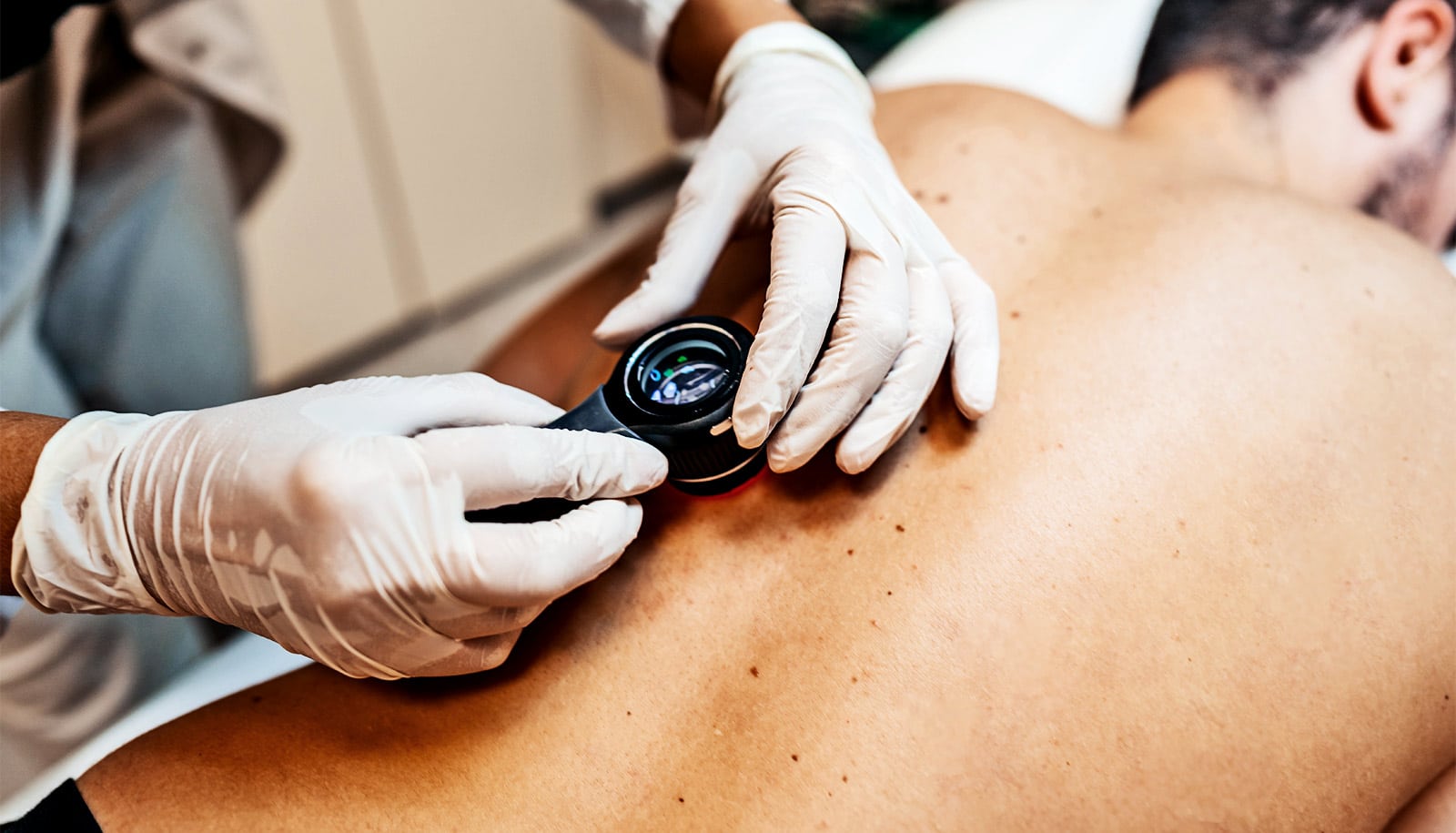 A doctor checks a man's back for melanoma with a handheld lens device.
