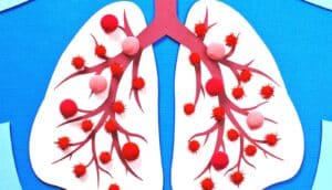 Paper cut out of lungs with fuzzy red balls on them to indicate respiratory infection.