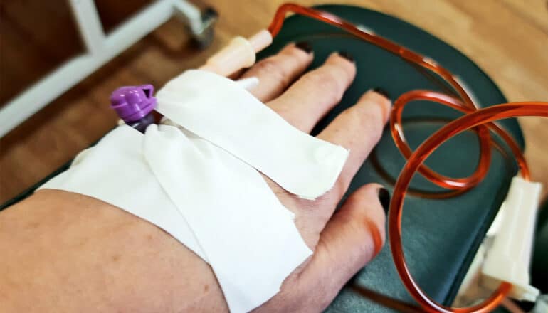 A person's hand with a line running into a vein delivering doxorubicin.