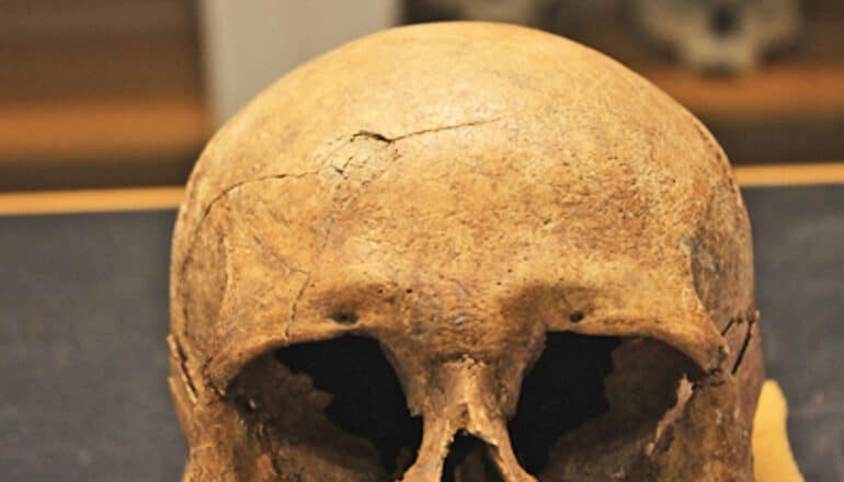 The top of a skull has a round crack in it.