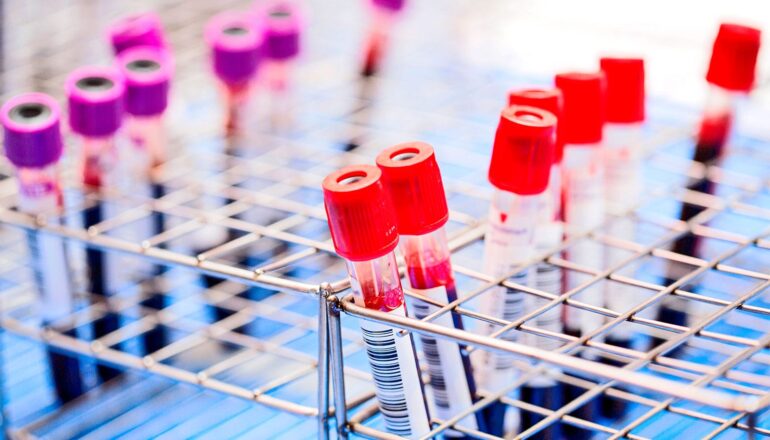Several blood test vials with red and purple caps.