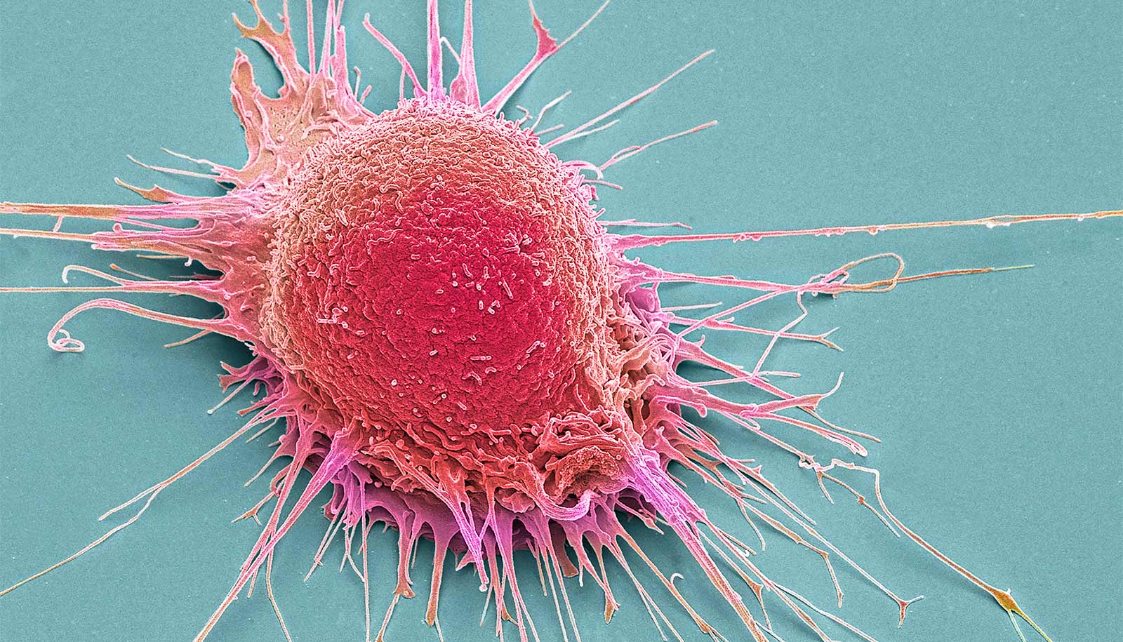 How prostate cancer turns immune cells into traitors