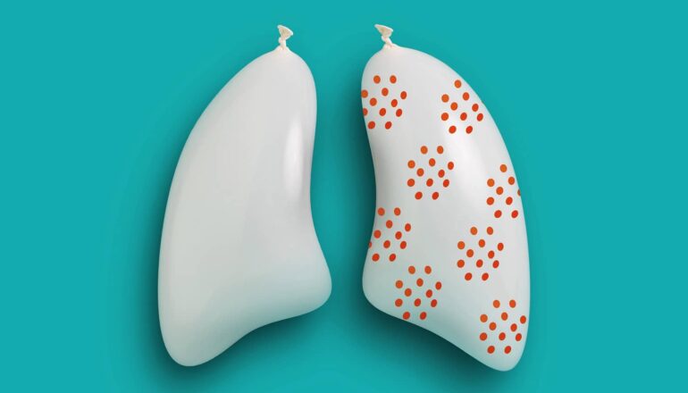 Discovery overturns ideas about small cell lung cancer’s start