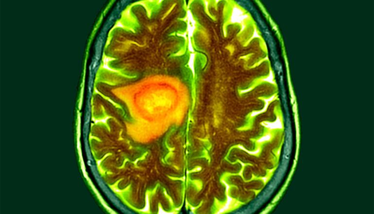 A brain scan shows a brain tumor highlighted in orange and yellow.