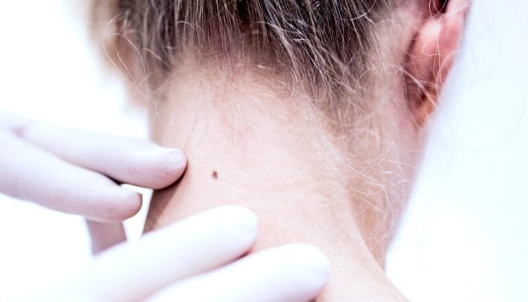 A doctor examines a mole on the back of a woman's neck.