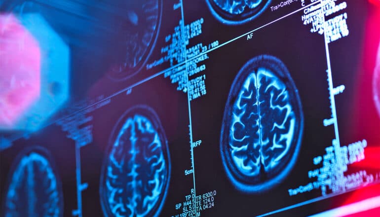 Rows of brain scans show up on a screen.