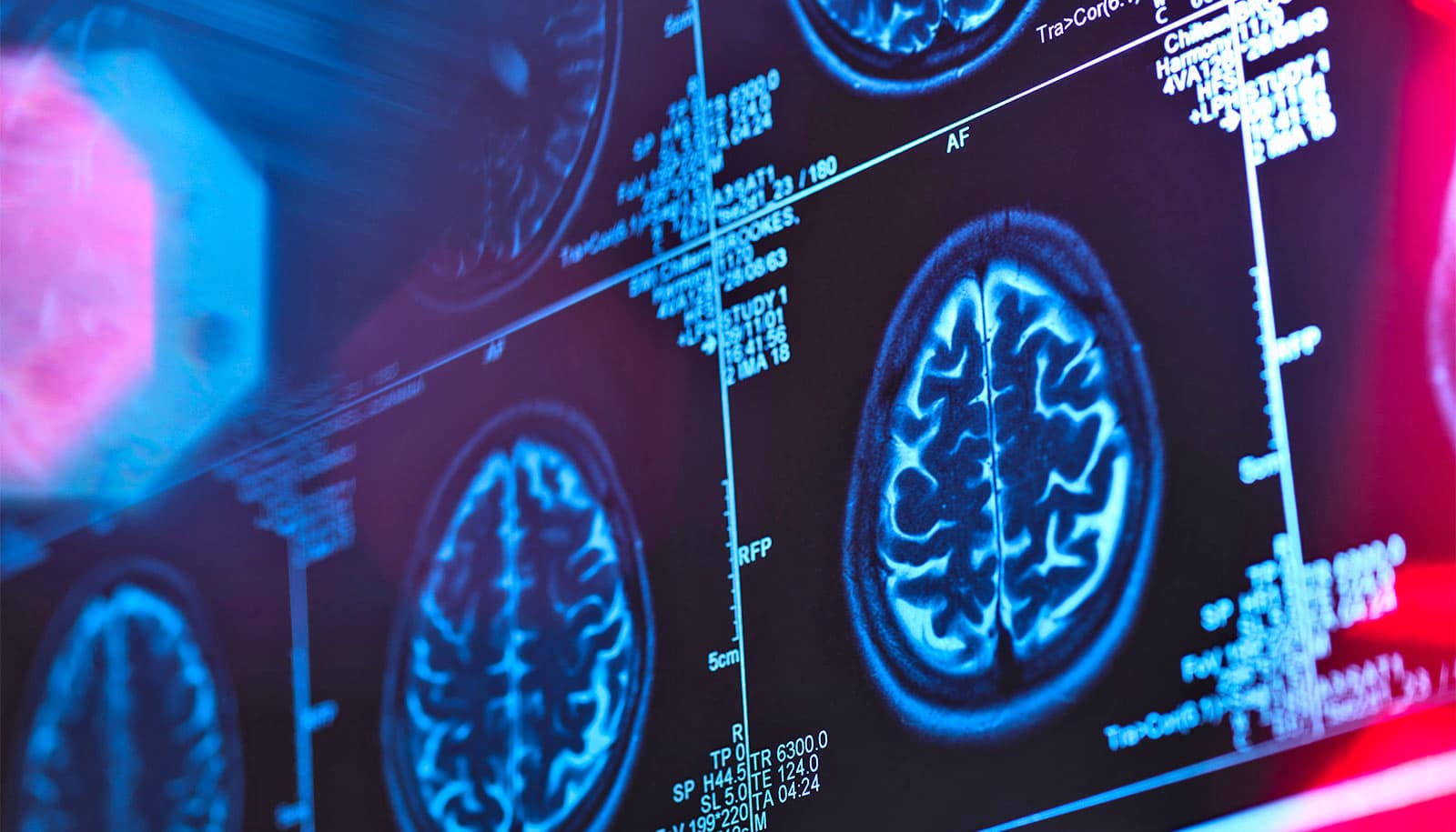 Alzheimer’s screening may work differently for men and women