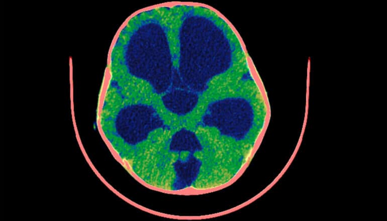 Discovery may upend ideas about the cause of hydrocephalus