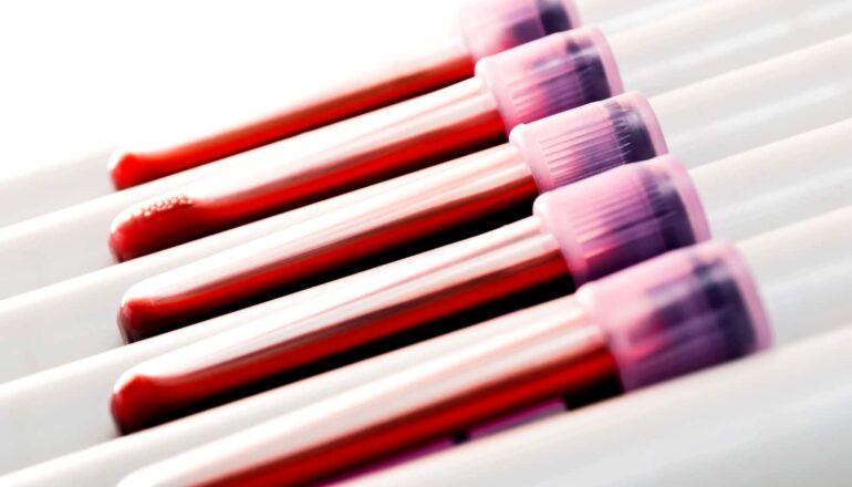 Team finds markers of inflammatory breast cancer in blood